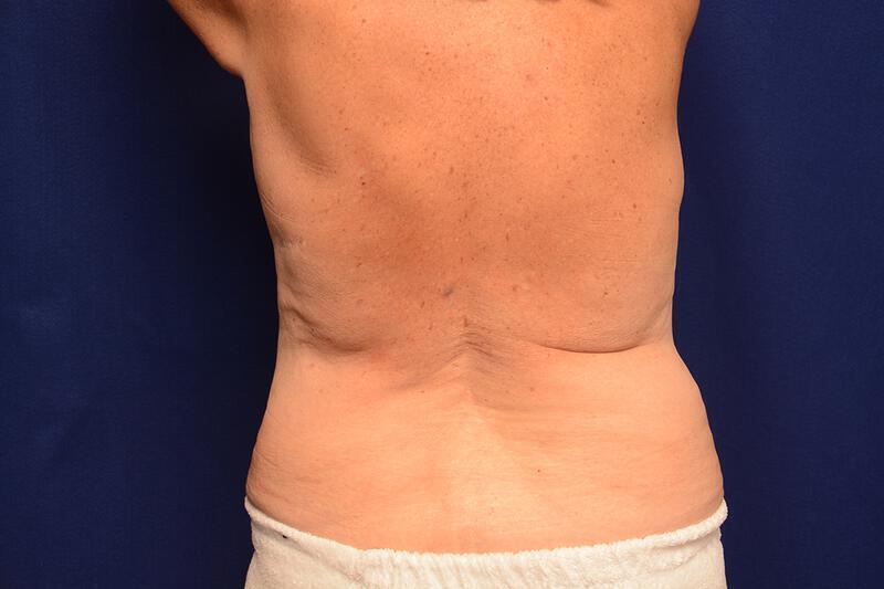 Body Lift Gallery Before & After Image