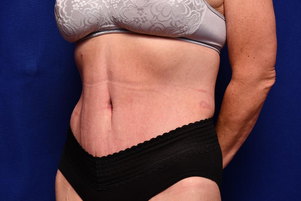 Body Lift Gallery Before & After Image