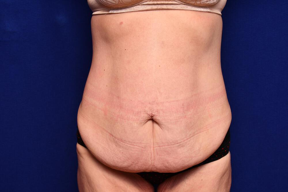 Body Lift Gallery Before & After Image