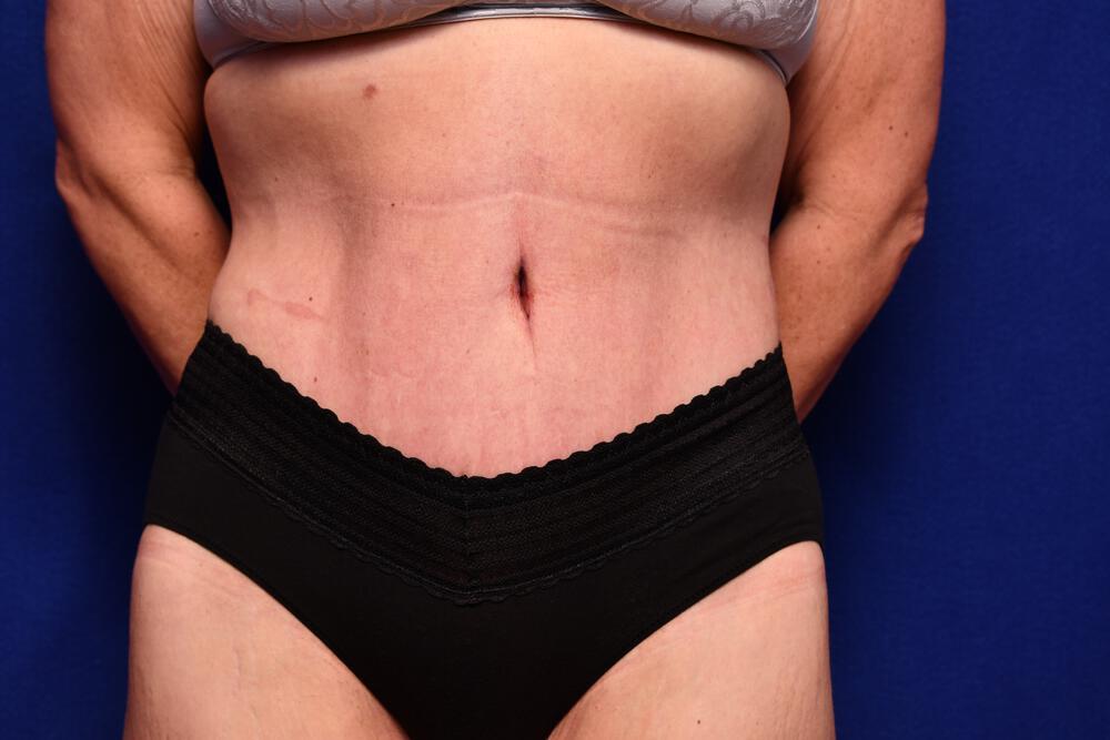 Body Lift Gallery Before & After Image