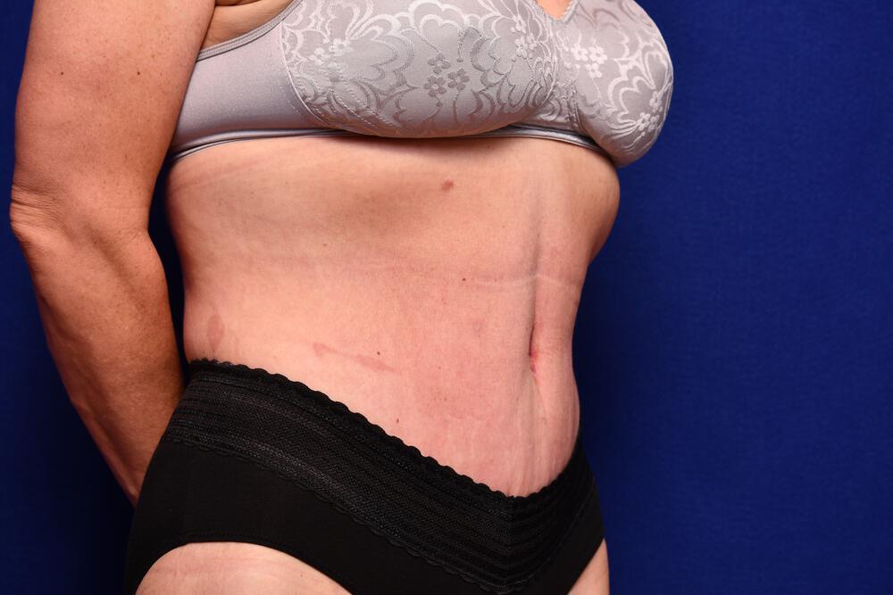 Body Lift Gallery Before & After Image