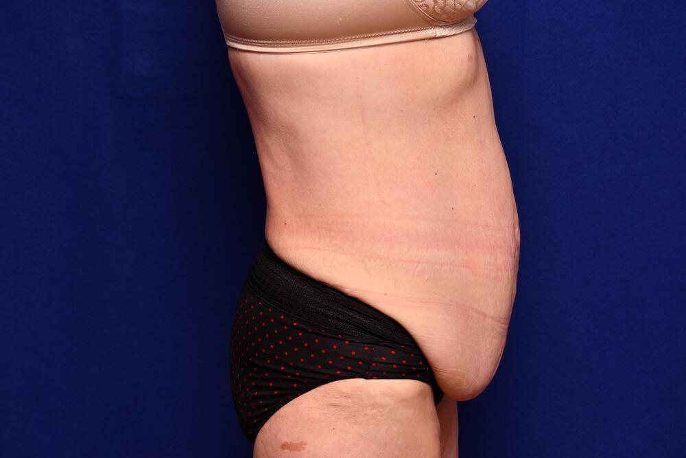 Body Lift Gallery Before & After Image