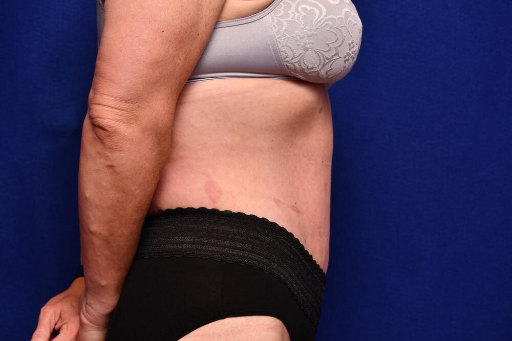 Body Lift Gallery Before & After Image