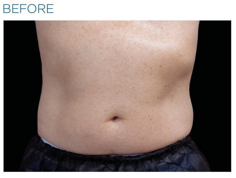 Emsculpt Abdomen Gallery Before & After Image