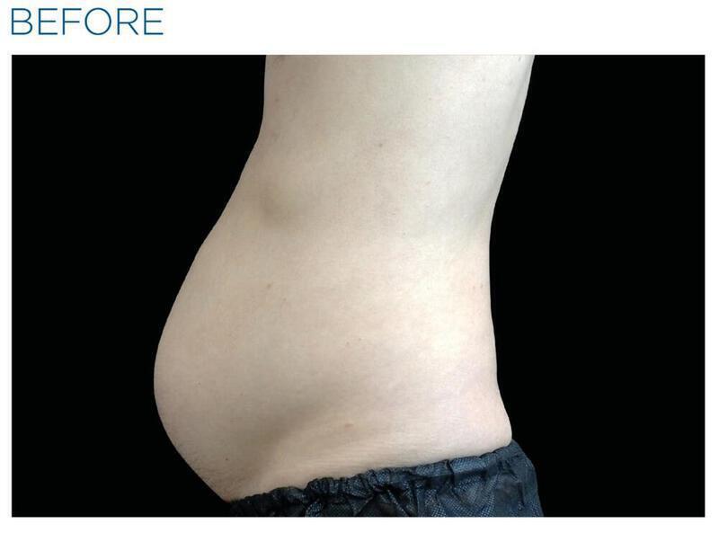 Emsculpt Abdomen Gallery Before & After Image