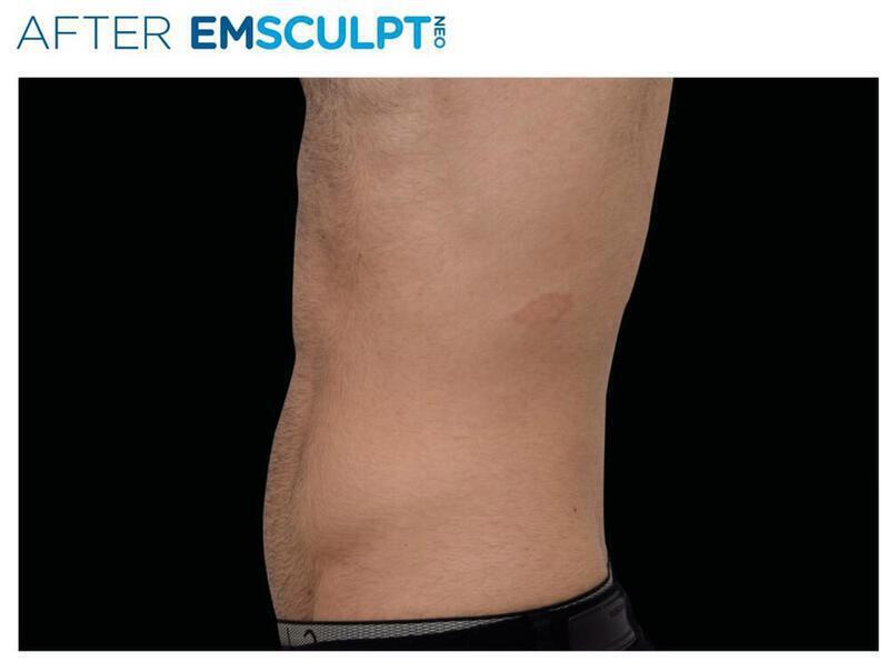 Emsculpt Abdomen Gallery Before & After Image