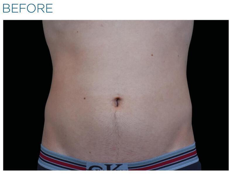 Emsculpt Abdomen Gallery Before & After Image