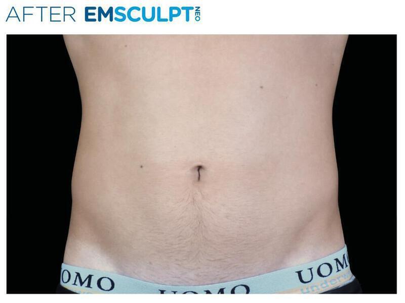 Emsculpt Abdomen Gallery Before & After Image