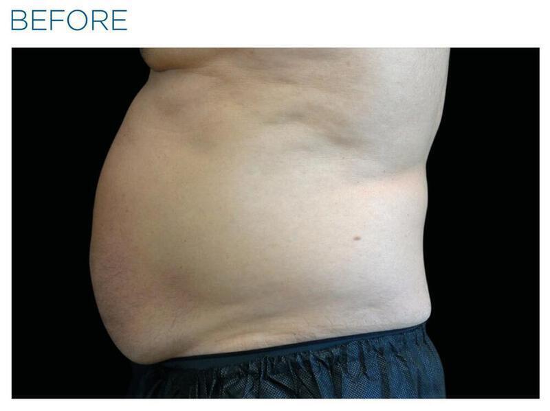 Emsculpt Abdomen Gallery Before & After Image