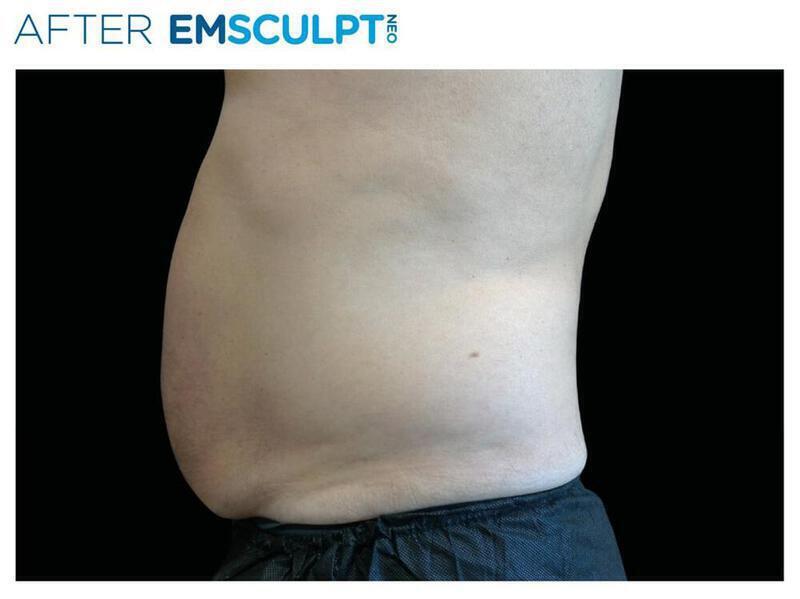 Emsculpt Abdomen Gallery Before & After Image