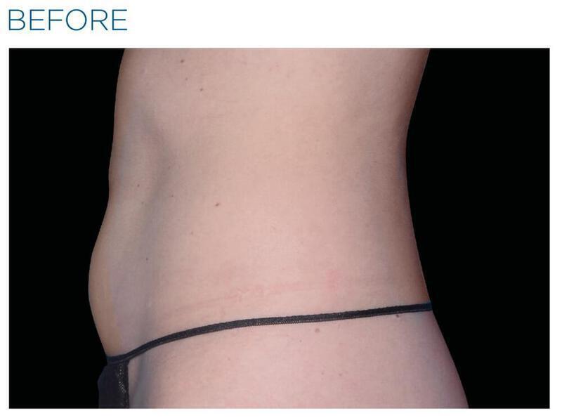 Emsculpt Abdomen Gallery Before & After Image