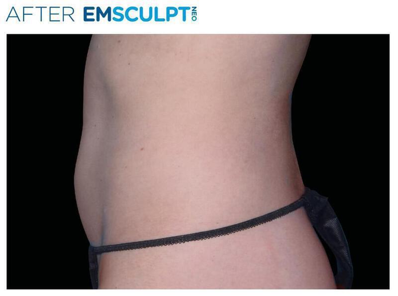 Emsculpt Abdomen Gallery Before & After Image