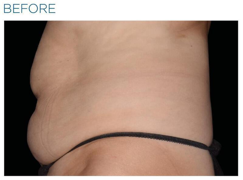 Emsculpt Abdomen Gallery Before & After Image