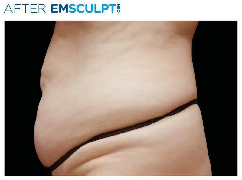 Emsculpt Abdomen Gallery Before & After Image