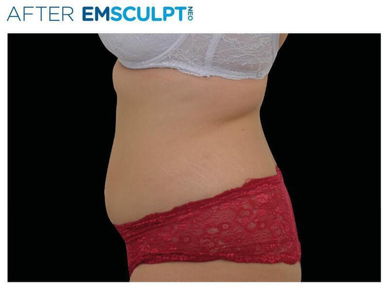 Emsculpt Abdomen Gallery Before & After Image