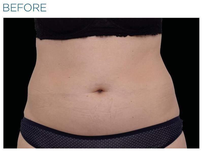 Emsculpt Abdomen Gallery Before & After Image