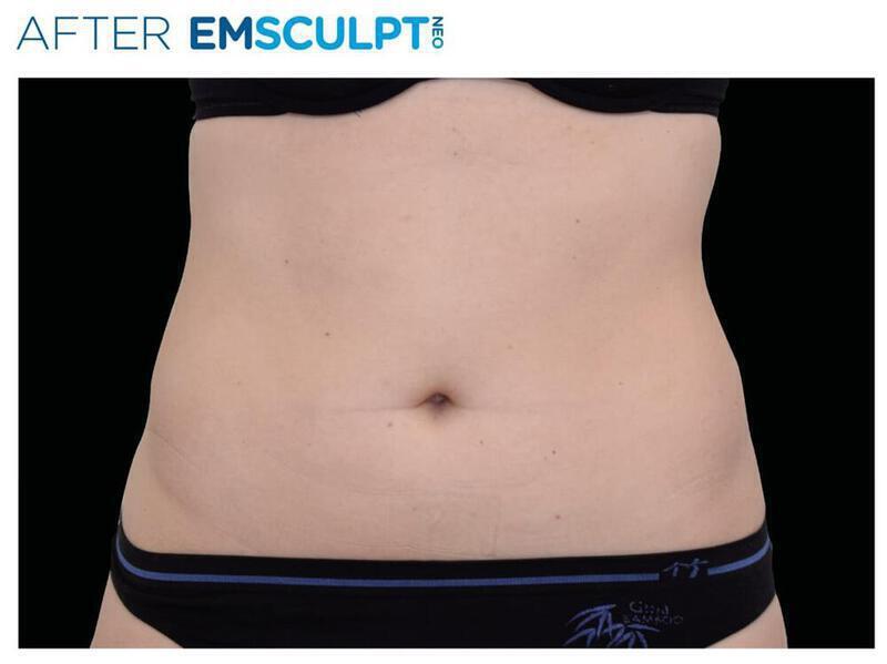 Emsculpt Abdomen Gallery Before & After Image