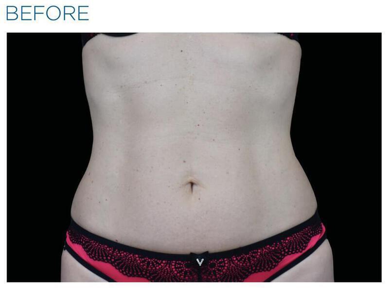 Emsculpt Abdomen Gallery Before & After Image