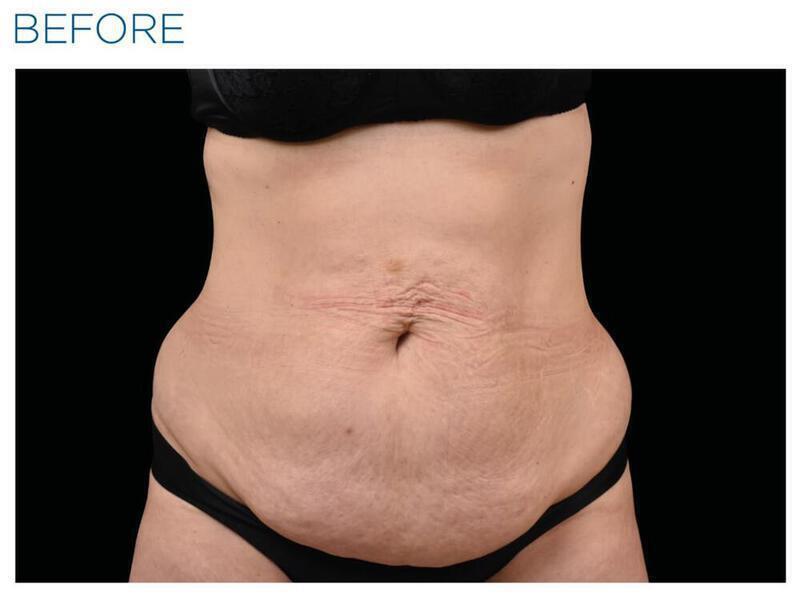 Emsculpt Abdomen Gallery Before & After Image