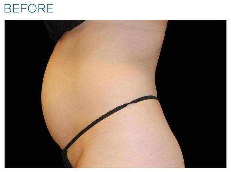 Emsculpt Abdomen Gallery Before & After Image