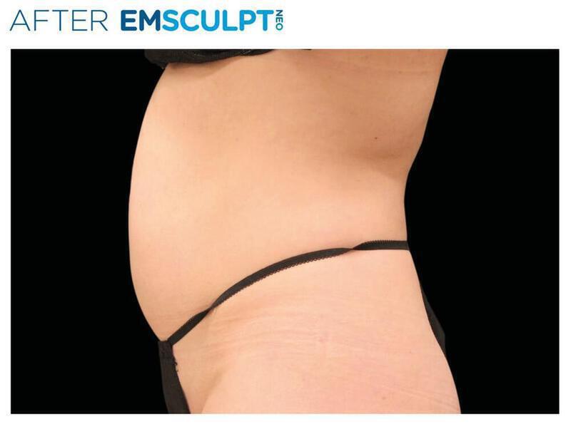 Emsculpt Abdomen Gallery Before & After Image