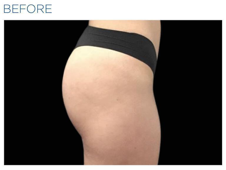 Emsculpt Gluteal Augmentation Gallery Before & After Image