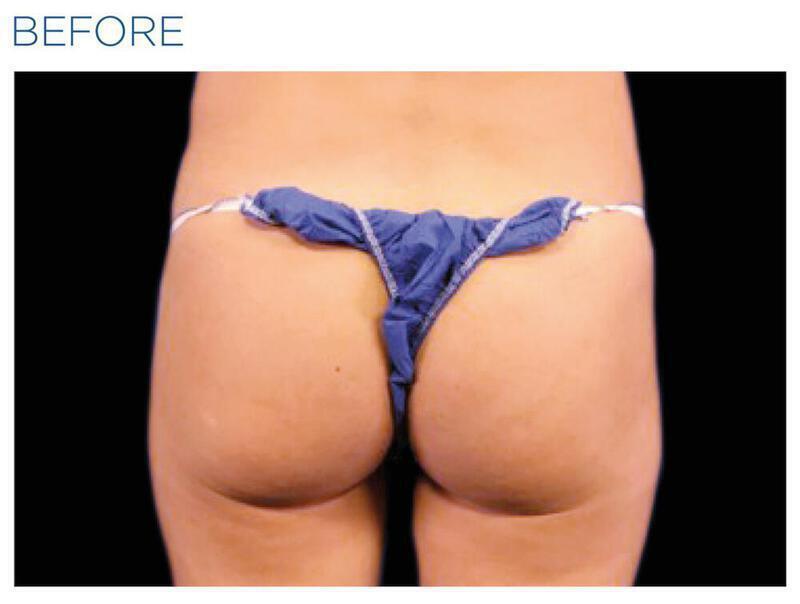 Emsculpt Gluteal Augmentation Gallery Before & After Image