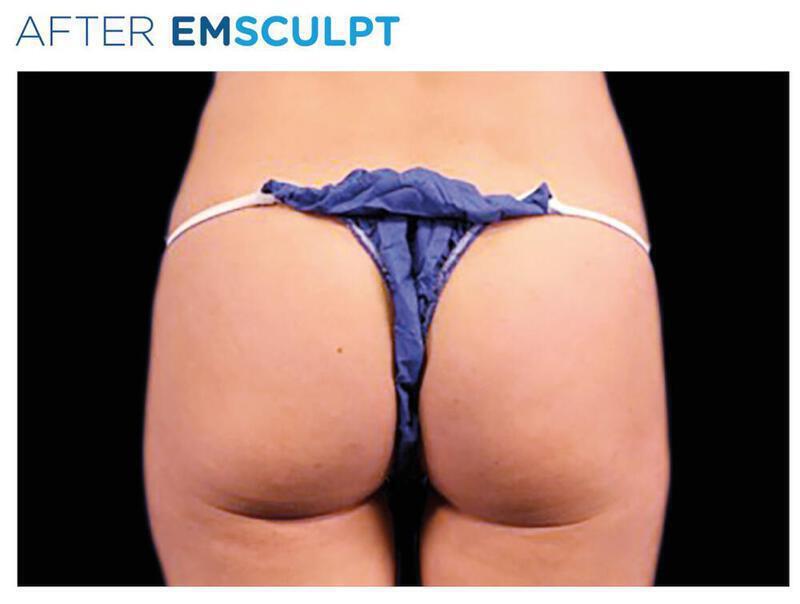 Emsculpt Gluteal Augmentation Gallery Before & After Image