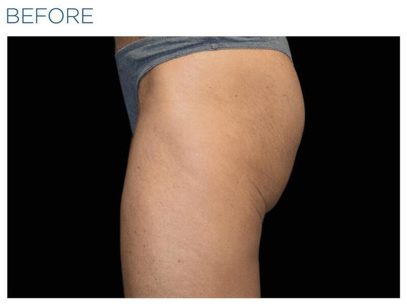 Emsculpt Gluteal Augmentation Gallery Before & After Image