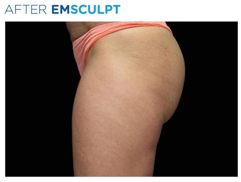 Emsculpt Gluteal Augmentation Gallery Before & After Image