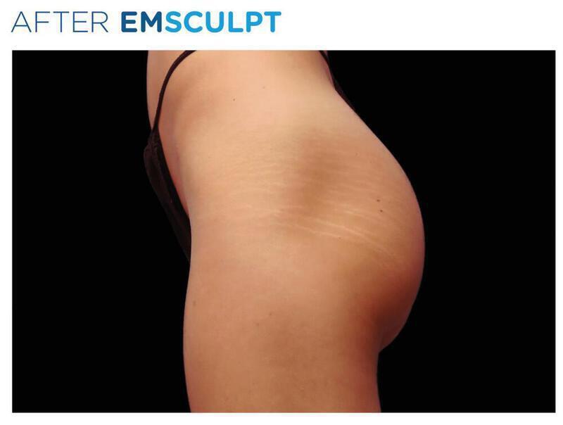 Emsculpt Gluteal Augmentation Gallery Before & After Image