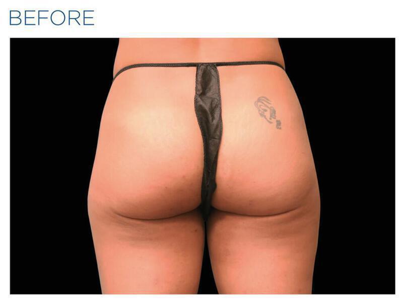 Emsculpt Gluteal Augmentation Gallery Before & After Image