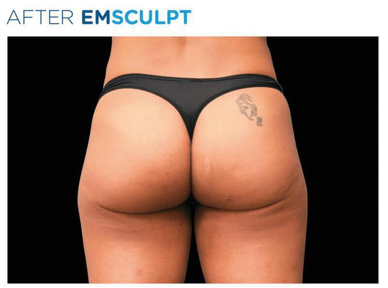 Emsculpt Gluteal Augmentation Gallery Before & After Image