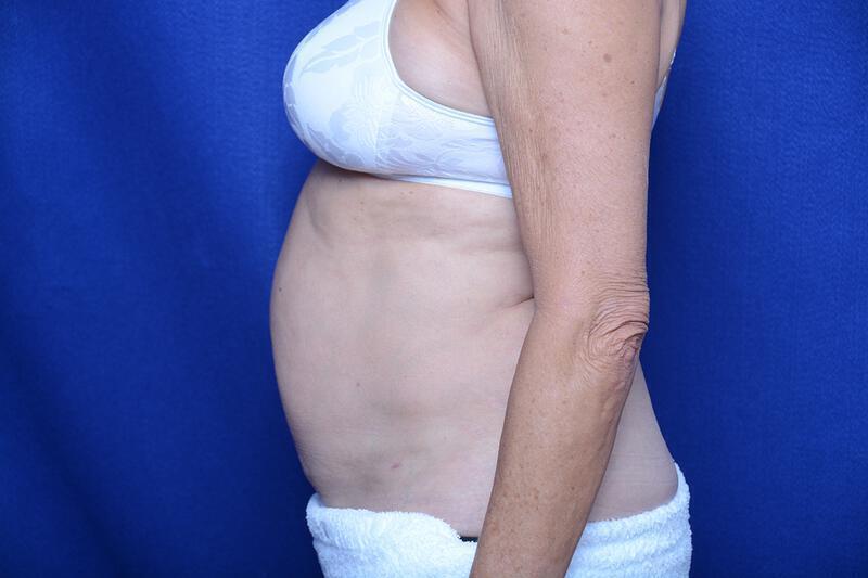 Liposuction Gallery Before & After Image