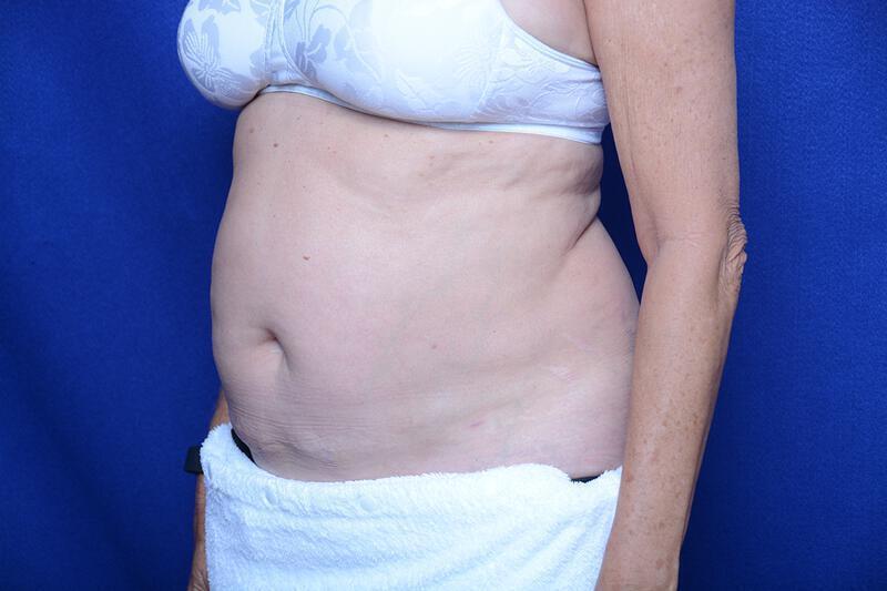 Liposuction Gallery Before & After Image