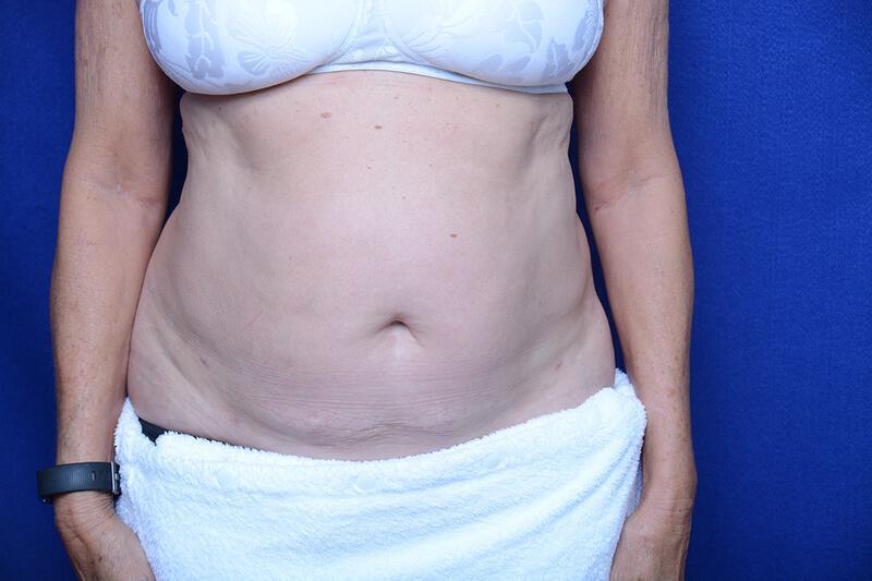 Liposuction Gallery Before & After Image