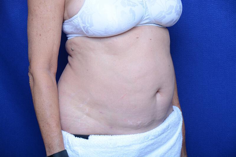 Liposuction Gallery Before & After Image