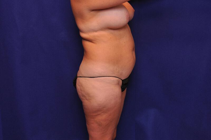 Liposuction Gallery Before & After Image