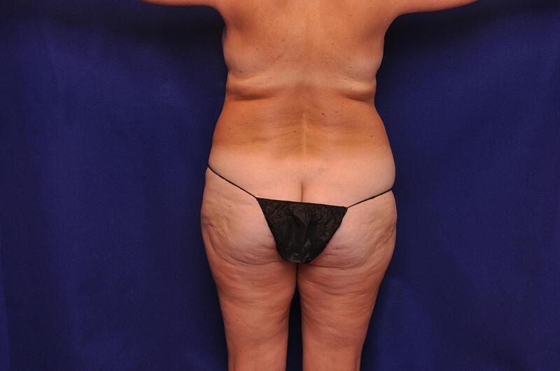 Liposuction Gallery Before & After Image