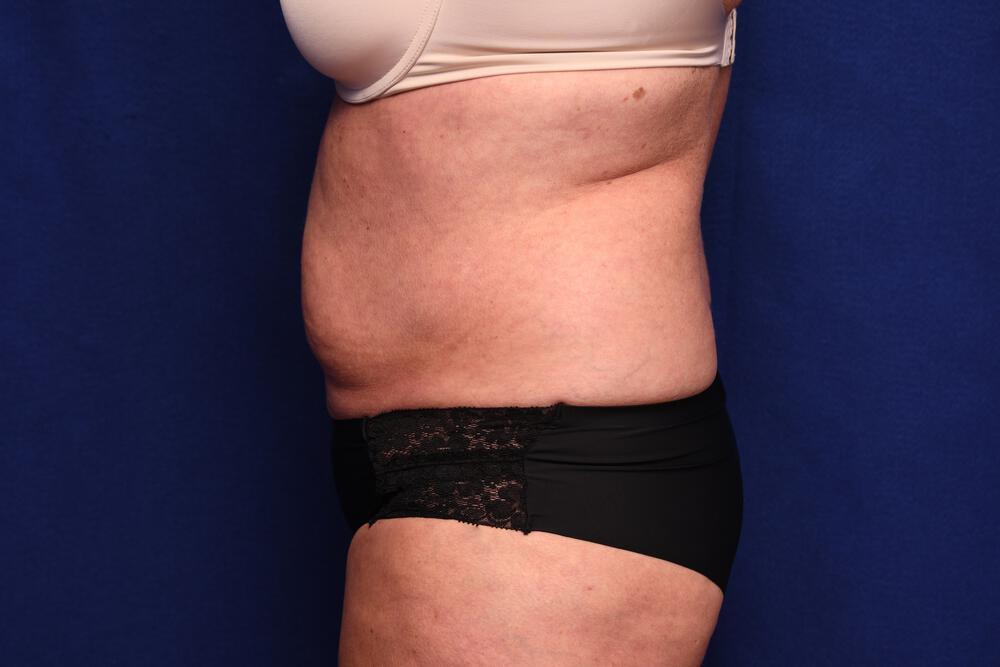 Abdominoplasty Gallery Before & After Image