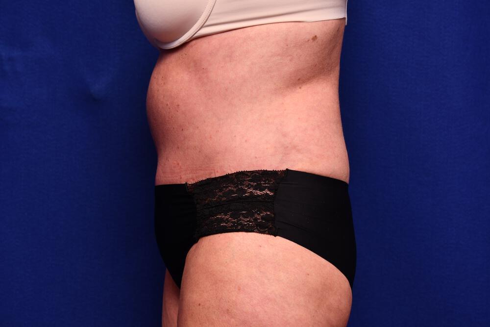 Abdominoplasty Gallery Before & After Image