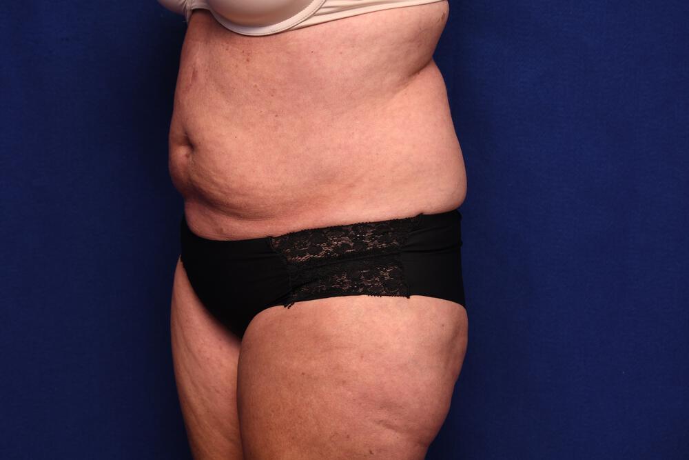 Abdominoplasty Gallery Before & After Image