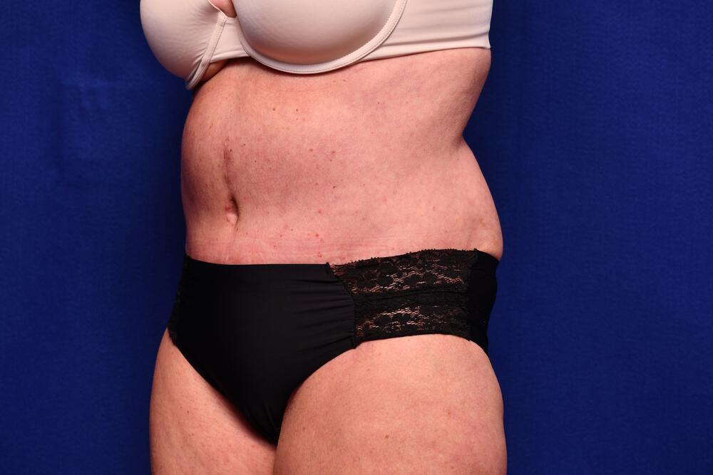 Abdominoplasty Gallery Before & After Image