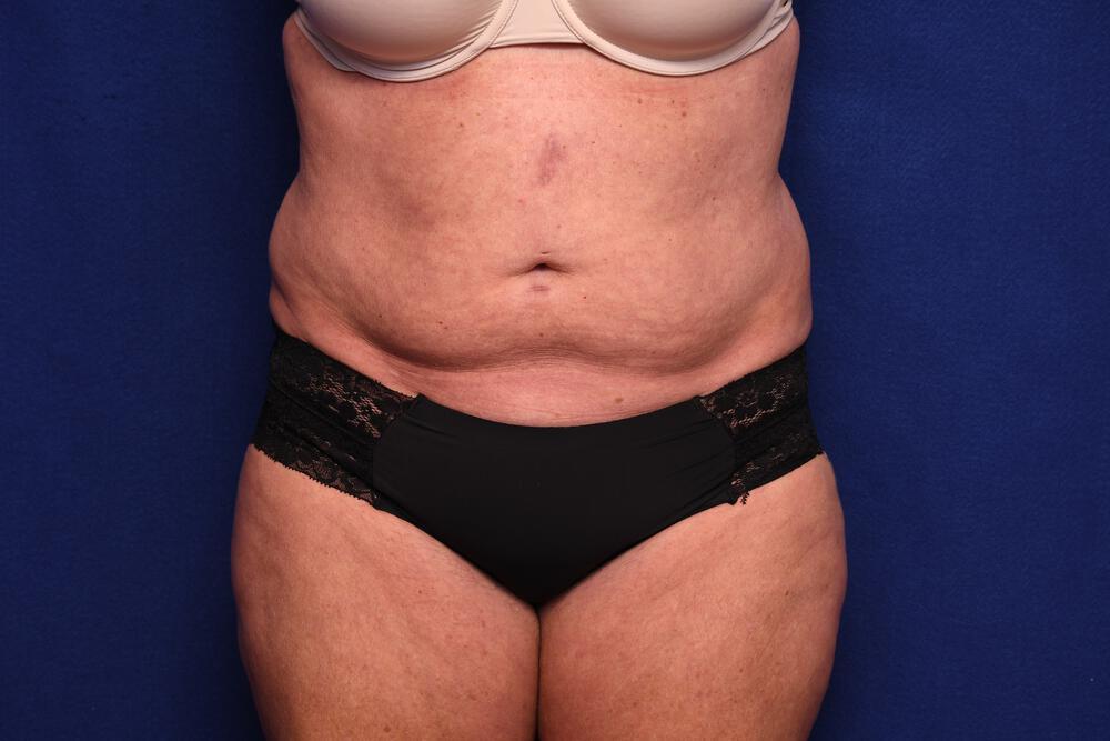 Abdominoplasty Gallery Before & After Image