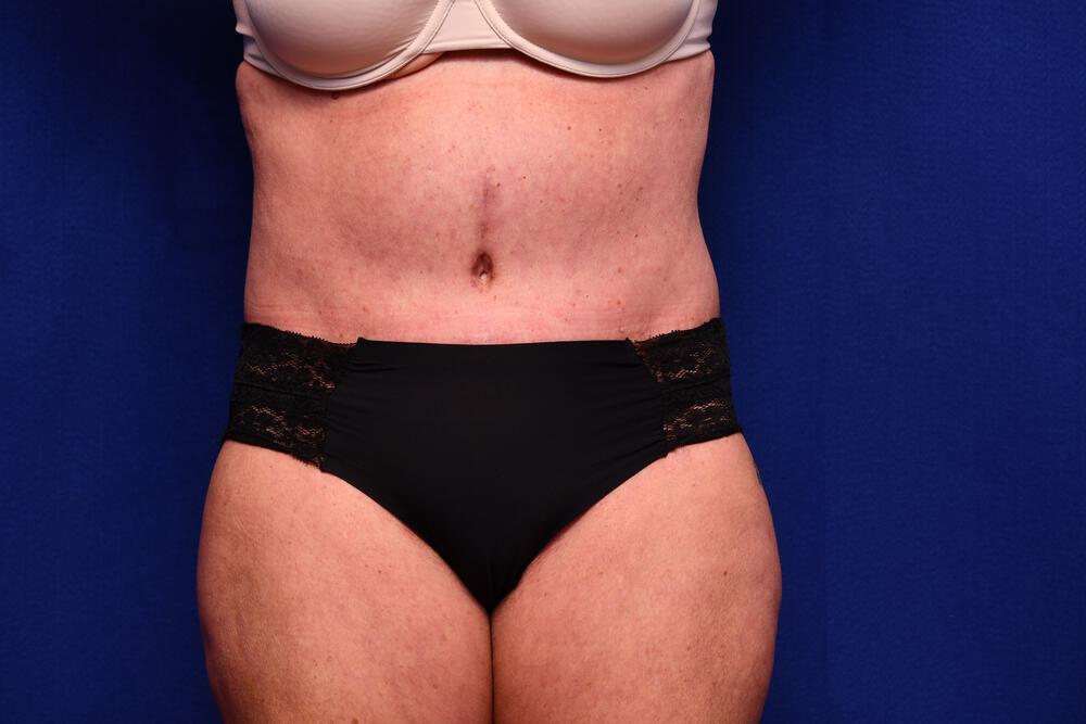 Abdominoplasty Gallery Before & After Image