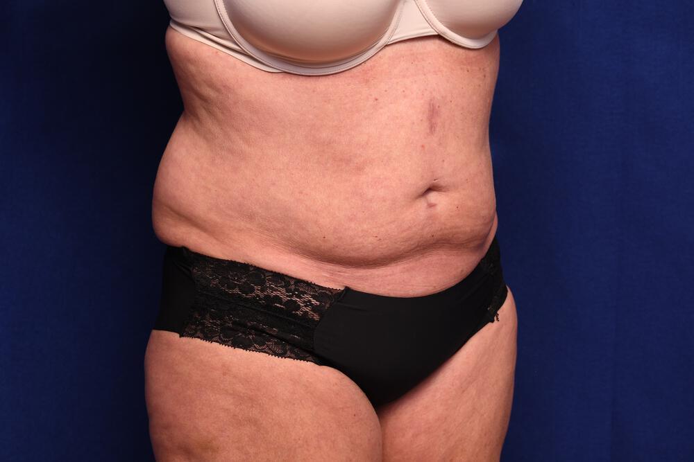 Abdominoplasty Gallery Before & After Image