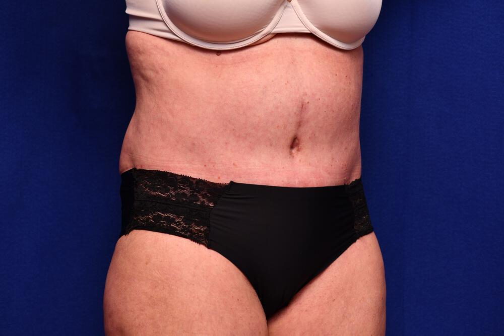 Abdominoplasty Gallery Before & After Image