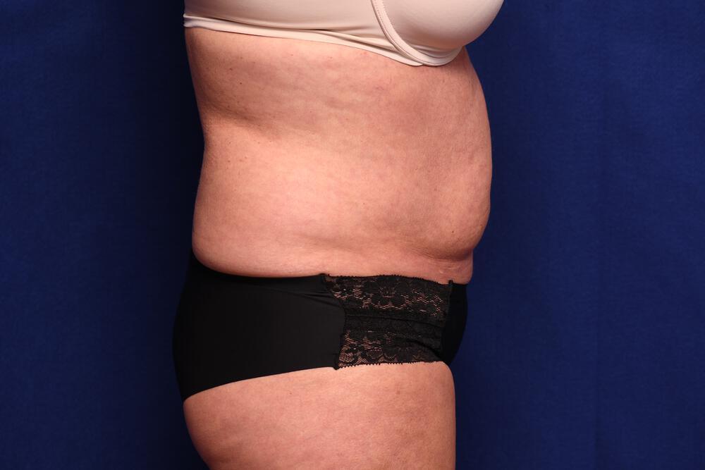 Abdominoplasty Gallery Before & After Image