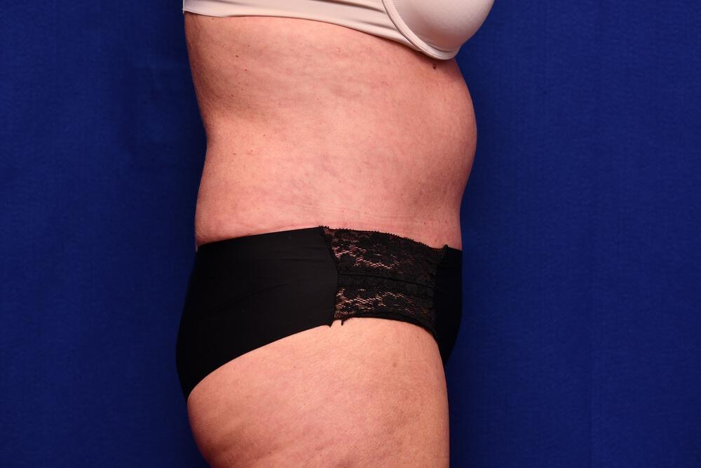 Abdominoplasty Gallery Before & After Image