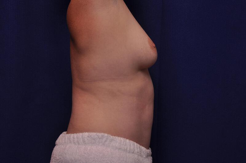 Abdominoplasty Gallery Before & After Image